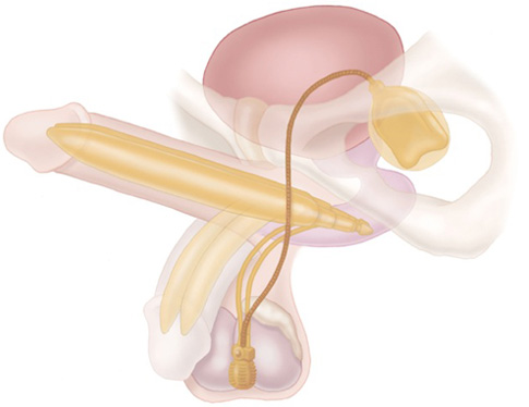 AMS 700™ CXR Penile Implant