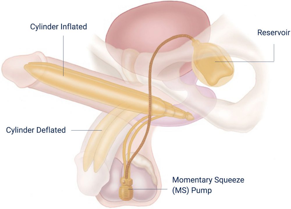 Illustration of Penile Prosthetic